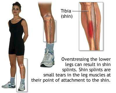 Shin splints are small tears in the leg muscles.